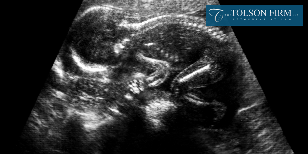 Best Atlanta Fetal Death Lawyer