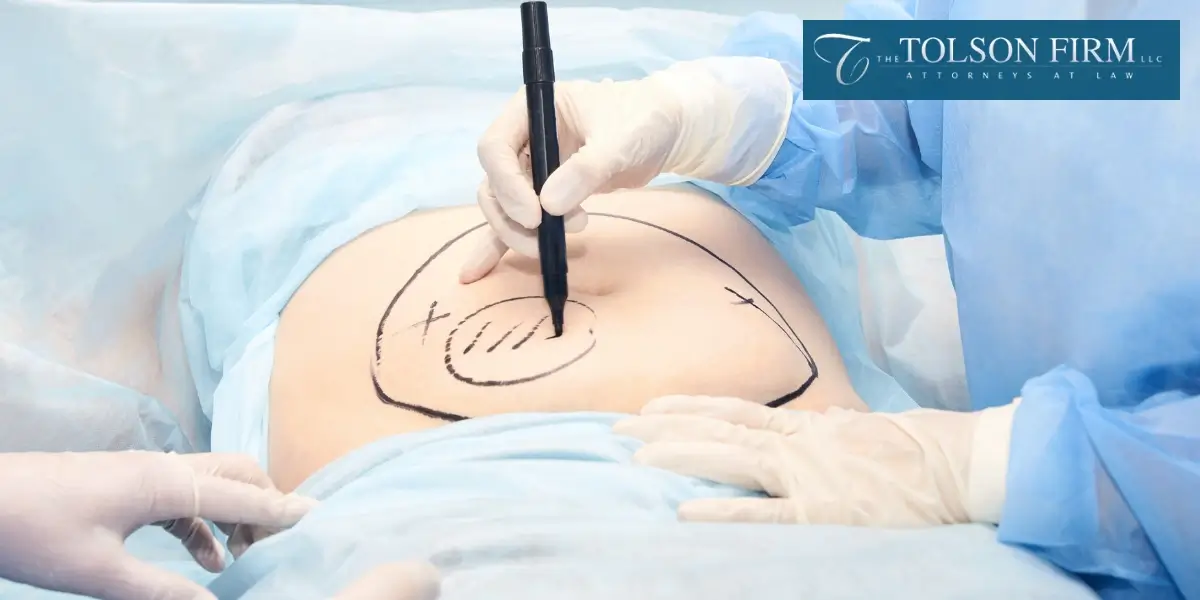 Best Atlanta Laser Liposuction Burn Lawyer