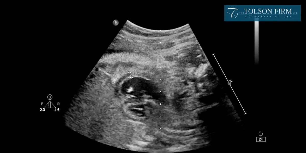 Leading Marietta Fetal Death Lawyer Leading Marietta Fetal Death Lawyer