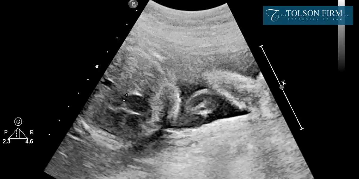 Trusted Roswell Fetal Death Attorney Trusted Roswell Fetal Death Attorney