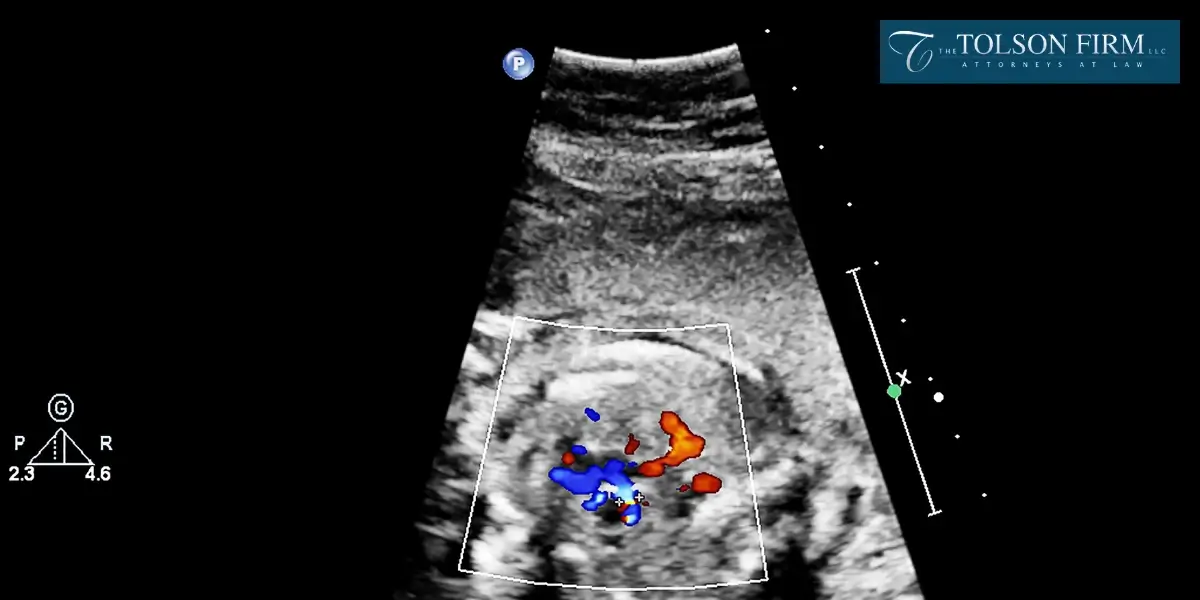 Experienced Roswell Fetal Death Lawyer Experienced Roswell Fetal Death Lawyer