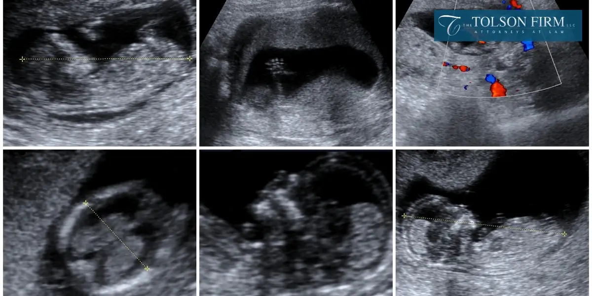 Dedicated Sandy Springs Fetal Death Lawyer Dedicated Sandy Springs Fetal Death Lawyer